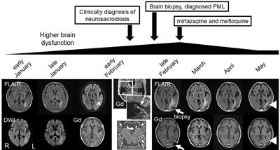 Case report: Progressive multifocal leukoencephalopathy co-occurring with neurosarcoidosis: early brain biopsy and appropriate therapy for PML resulted in a favorable prognosis